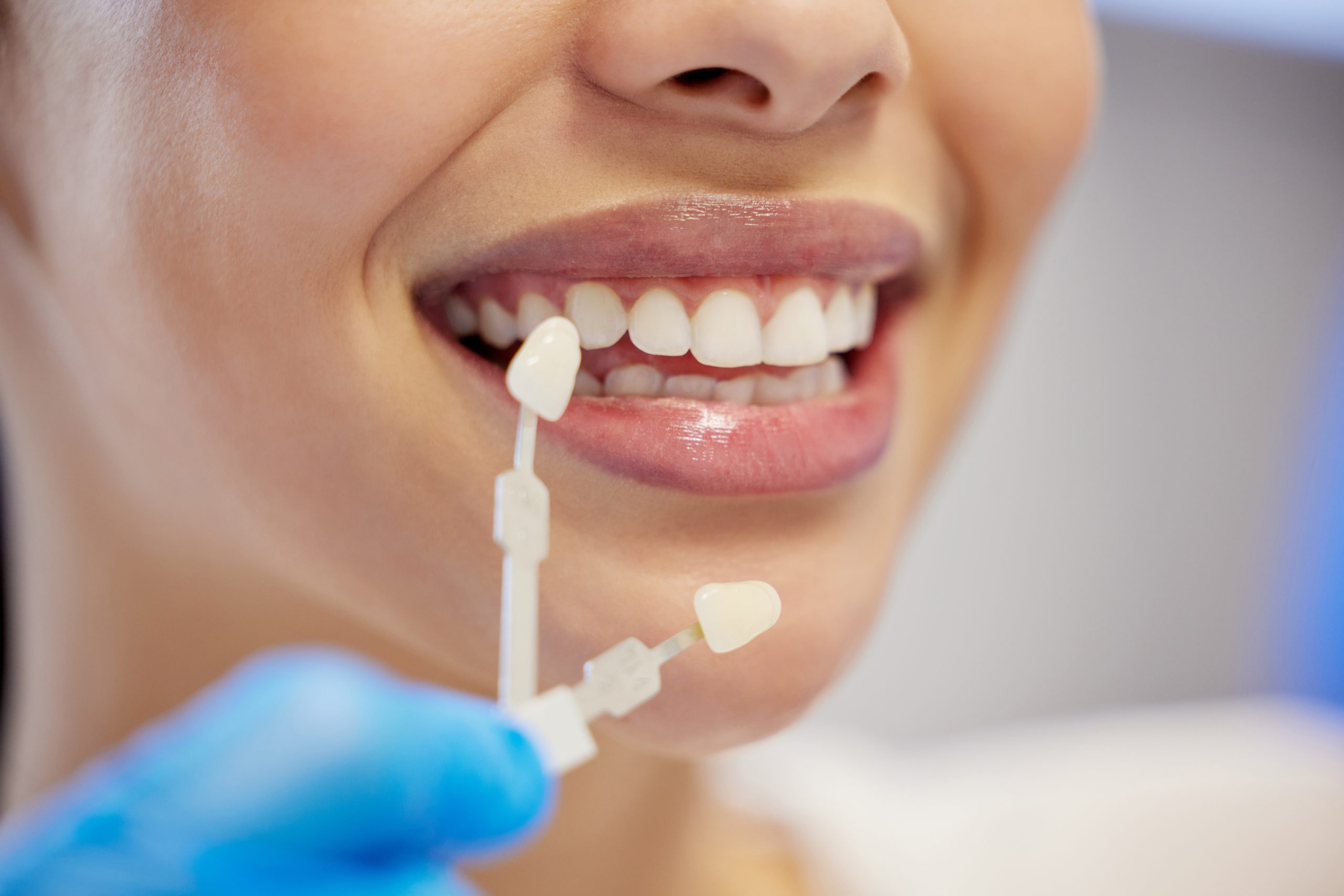 Todo lo que debes saber sobre Carillas Dentales